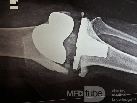 Aseptic Loosening with Distal Femur Bone Loss 
