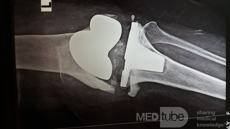 Aseptic Loosening with Distal Femur Bone Loss 