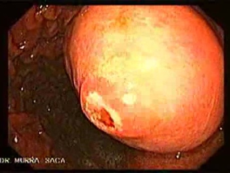 GIST With Ulcerated Lesion (3 of 6)