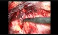 Laparoscopic Groin Hernia Repair, Step 5: Left Side Dissection