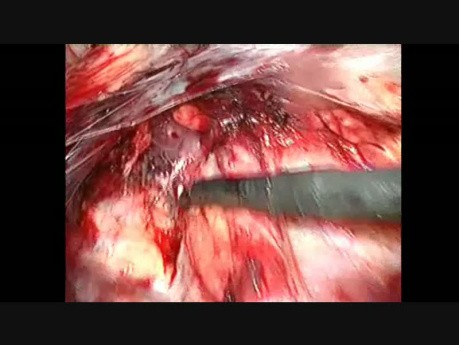 Laparoscopic Groin Hernia Repair, Step 5: Left Side Dissection