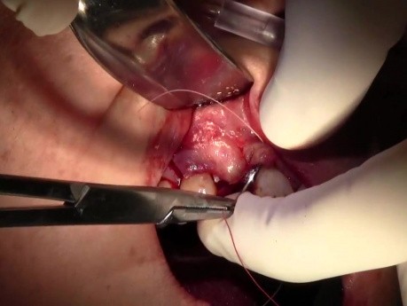 Extraction #7 with Socket Grafting - Cytoplast d-PTFE & Mineross