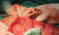 Strangulated Inguinal Hernia