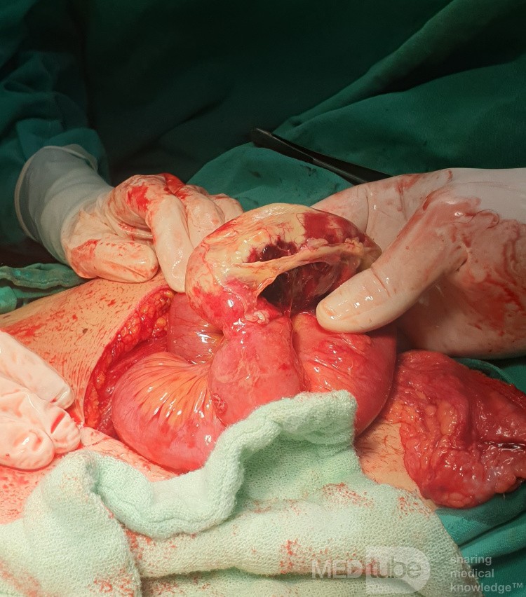 Strangulated Inguinal Hernia
