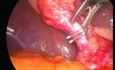 Cholecystectomy video