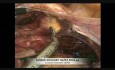Laparoscopic Hysterectomy