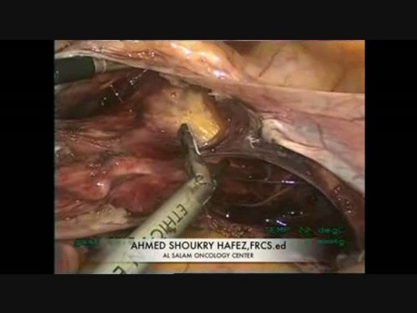 Laparoscopic Hysterectomy