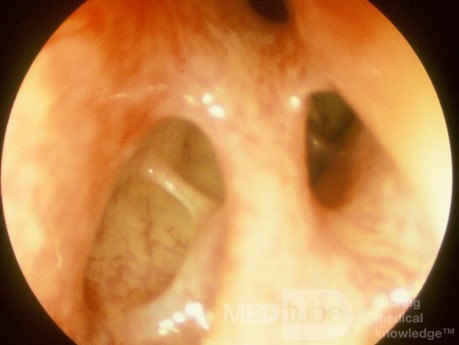 Normal Frontal Recess [left]