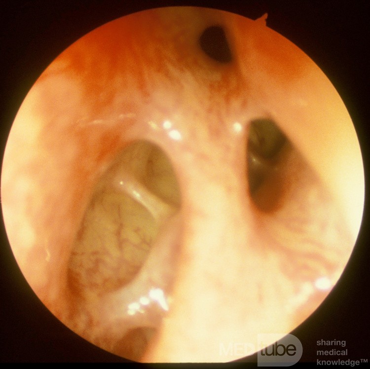 Normal Frontal Recess [left]