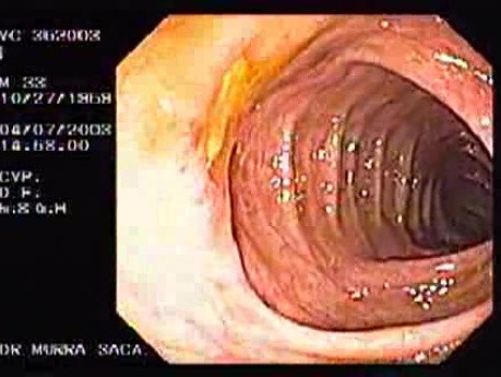 Endoscopic View of Amebiasis Colitis (4 of 7)