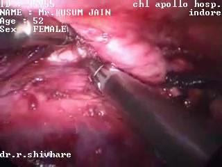 Thoracoscopic esophagectomy - 52 year old female