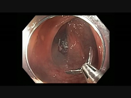 Colonoscopy - Ascending Colon EMR - En bloc resection of a 2 cm lesion