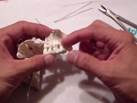 Mandible Fracture - Ivy Loop Fixation - Maxilla Kitchen Table