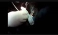 Expandable Device For Aortic Anastomosis In A Case Of ULL Cancer Infiltrating The Distal Aortic Arch