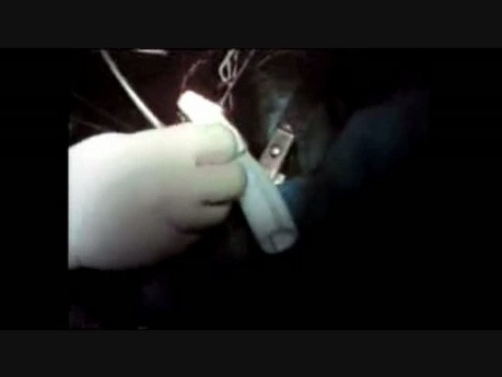 Expandable Device For Aortic Anastomosis In A Case Of ULL Cancer Infiltrating The Distal Aortic Arch