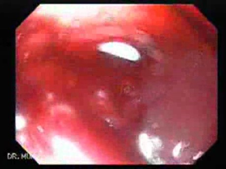 Dilation of the Stricture Caused by Adenocarcinoma, Part 1
