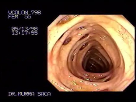 Diverticular Disease