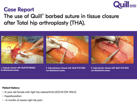 Case Report The Use of Quill® Barbed Suture in Tissue Closure After Total Hip Arthroplasty (THA)