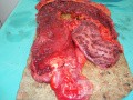 Multiple Rectal Ulcers (91 of 110)