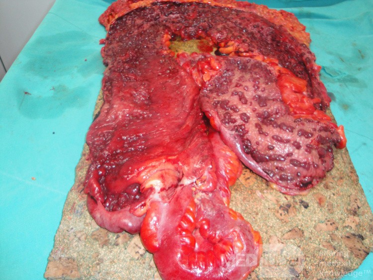 Multiple Rectal Ulcers (91 of 110)