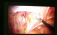 Laparoscopic Inguinal Hernia Repair, TAPP