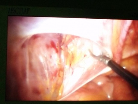 Laparoscopic Inguinal Hernia Repair, TAPP