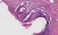 Squamous metaplasia And carcinoma-in-si - Histopathology - Cervix