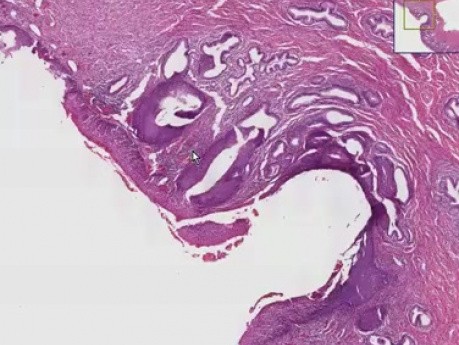 Squamous metaplasia And carcinoma-in-si - Histopathology - Cervix