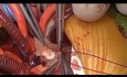 Domino Heart Transplantation 