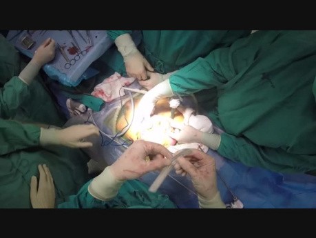 Laparoscopic Radical Cistectomy