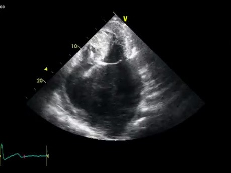 Hypertrophy of Left Antrium