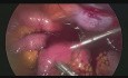 Hemorrhage from Inferior Epigastric Artery