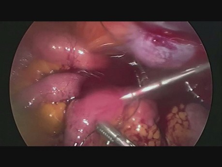 Hemorrhage from Inferior Epigastric Artery