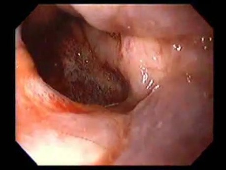 Severe Epistaxis - Case Study  (6 of 8)