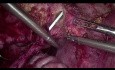 Laparoscopic Uretero-Vesical Reimplantation