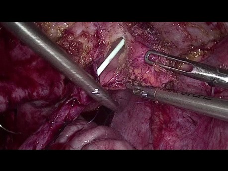 Laparoscopic Uretero-Vesical Reimplantation
