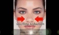 How to Tape Nose After Rhinoplasty advised by Dr Hosnani