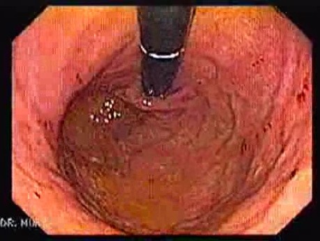 Gastric fundus