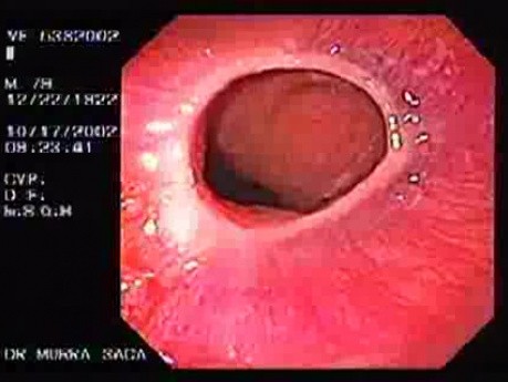 Esophagus Schatzki Ring (1 of 3)