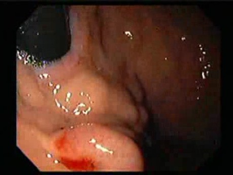 Gastric Varices - Endoscopic Ablation With Cyanoacrylate Glue (3 of 18)