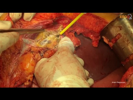 Ovarian Cancer Cytoreductive Surgery. Right Upper Quadrant Peritonectomy. Answering Ten Frequently Asked Questions.