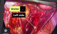 Obturator Nerve Endometriosis Treat by Peritonectomy 