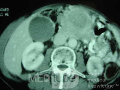 Gastric Ulcer with Gastrocolic fistula due to a Zollinger-
 Ellison Syndrome (33 of 33)