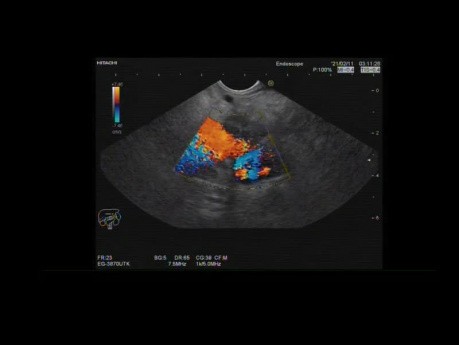  Endoscopic Ultrasound of Pancreatic Mass with FNA