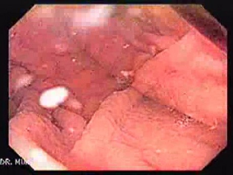 Gastric Folds - Magnifying Endoscopy (1 of 8)