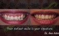Braces Time-lapse - Deep Bite Progress