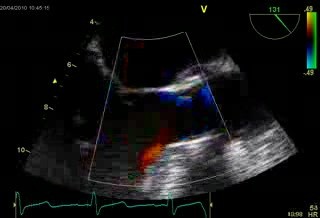 Aortic Valve Post Inflation  