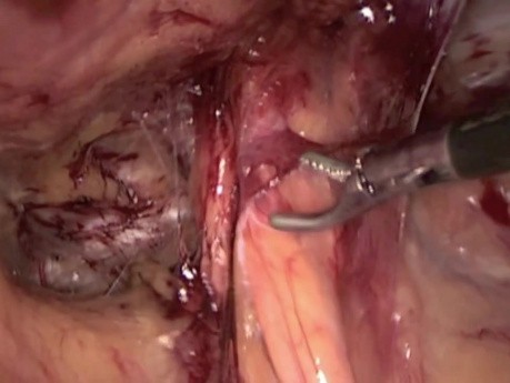 TAPP method in hernia repair