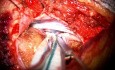 Right Retro Sigmoid Craniotomy and Resection of Vestibular Schwannoma