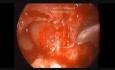 Endoscopic Tympanomastiodectomy